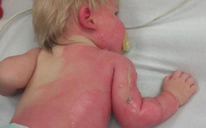 Mẹo sơ cứu nhanh khi trẻ bị bỏng